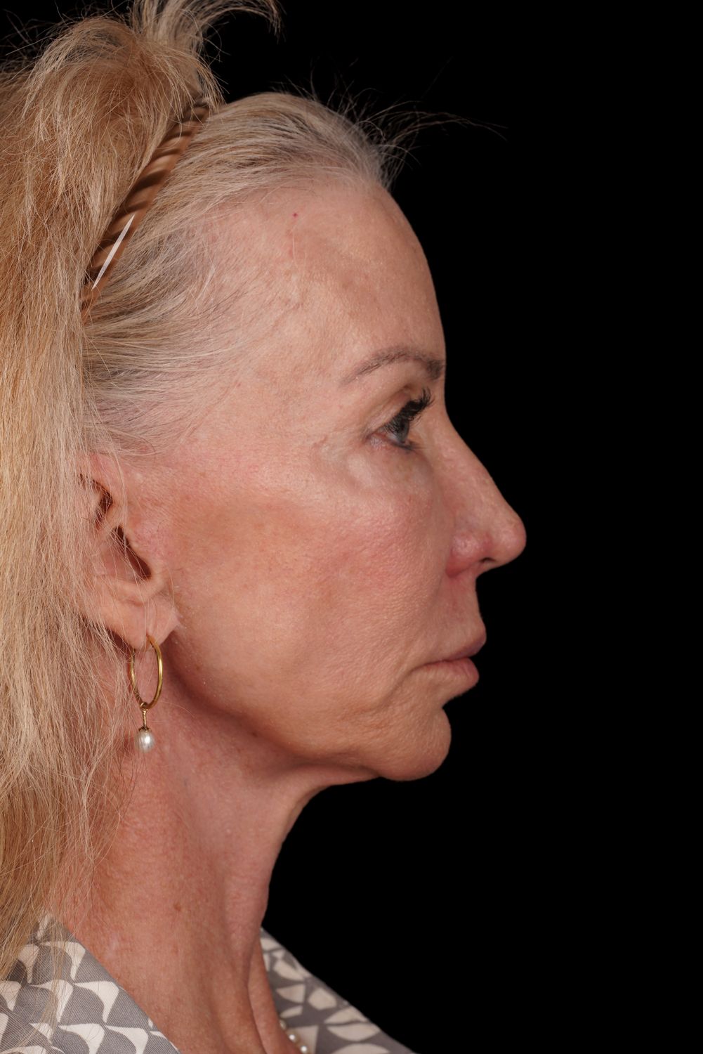 Eyelid Surgery Before & After