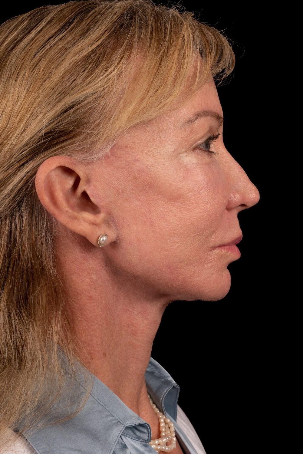 Eyelid Surgery Before & After