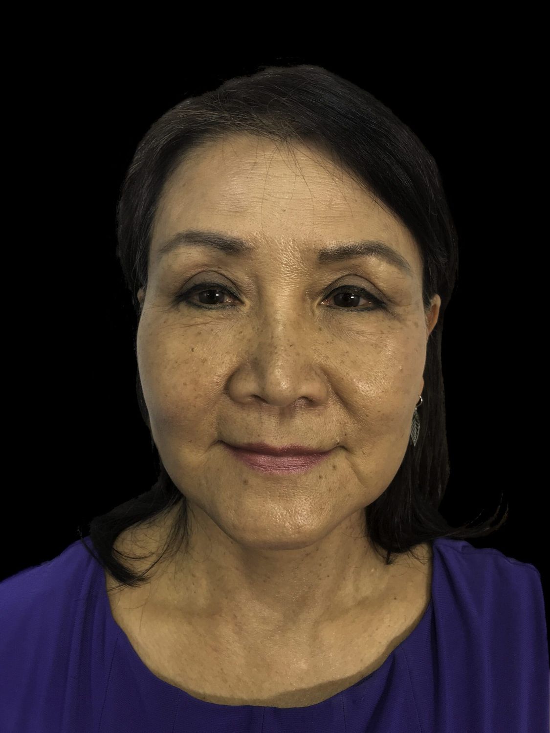 Eyelid Surgery Before & After