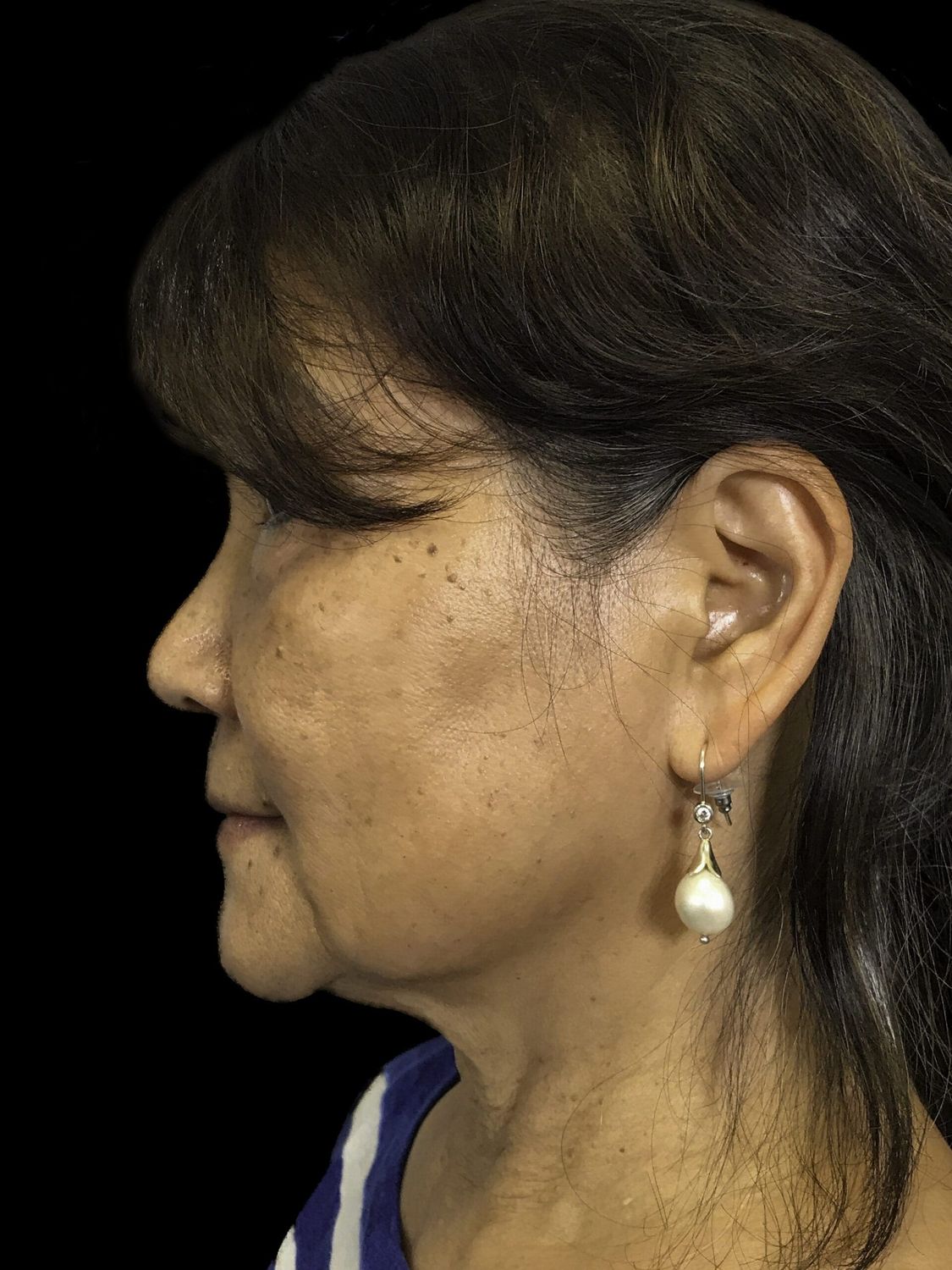 Eyelid Surgery Before & After