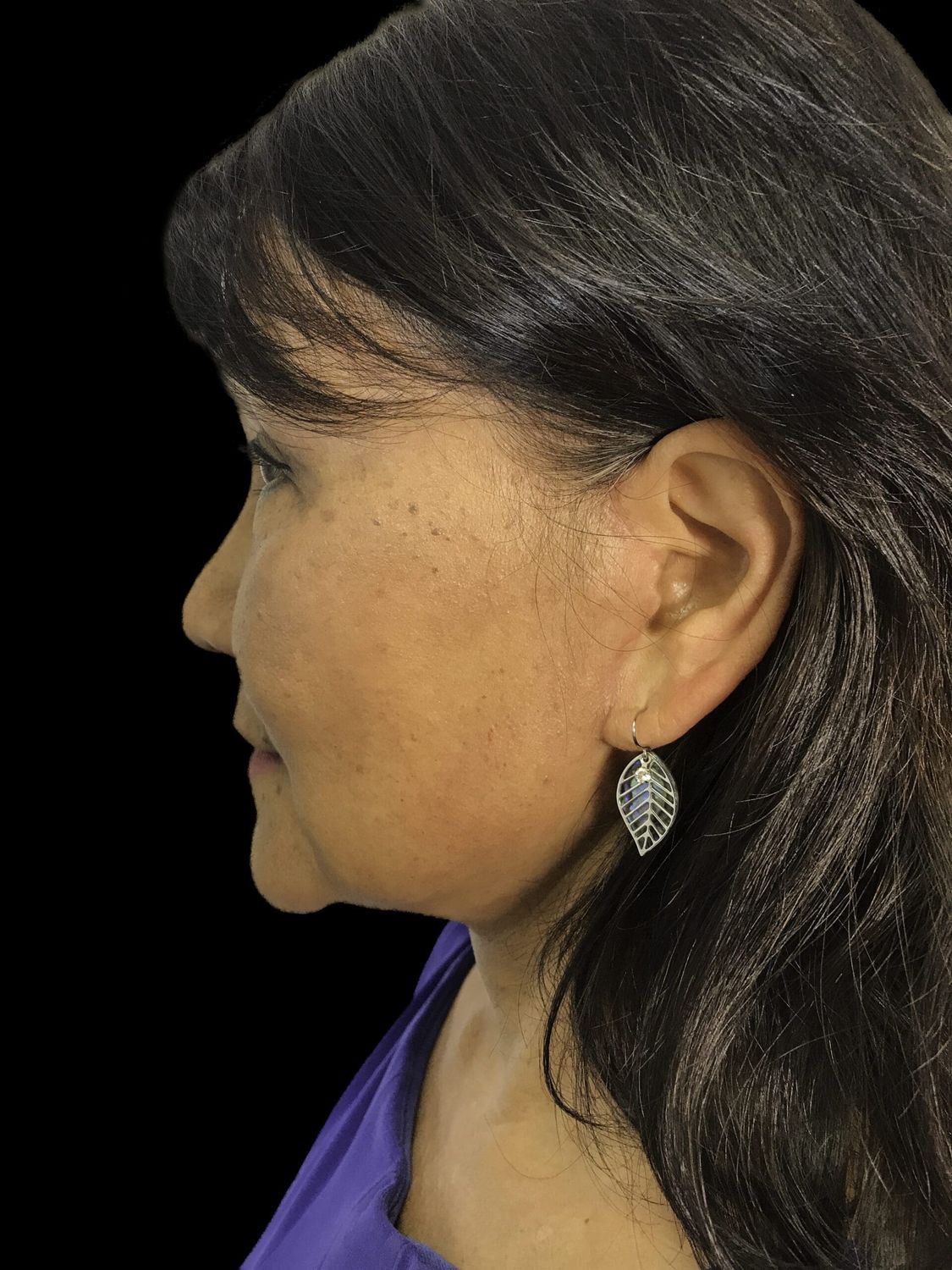 Eyelid Surgery Before & After