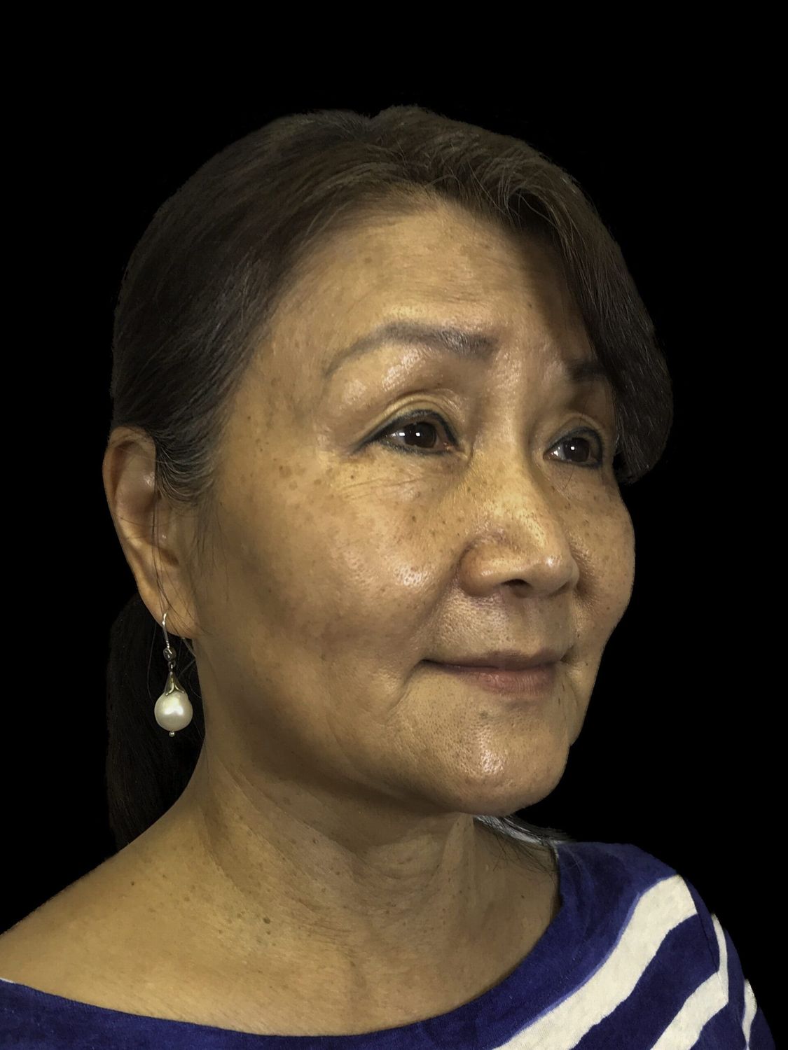 Eyelid Surgery Before & After