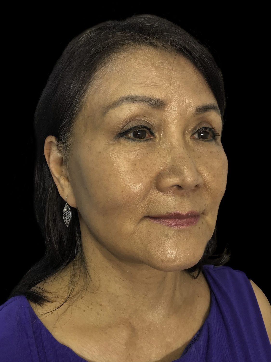 Eyelid Surgery Before & After