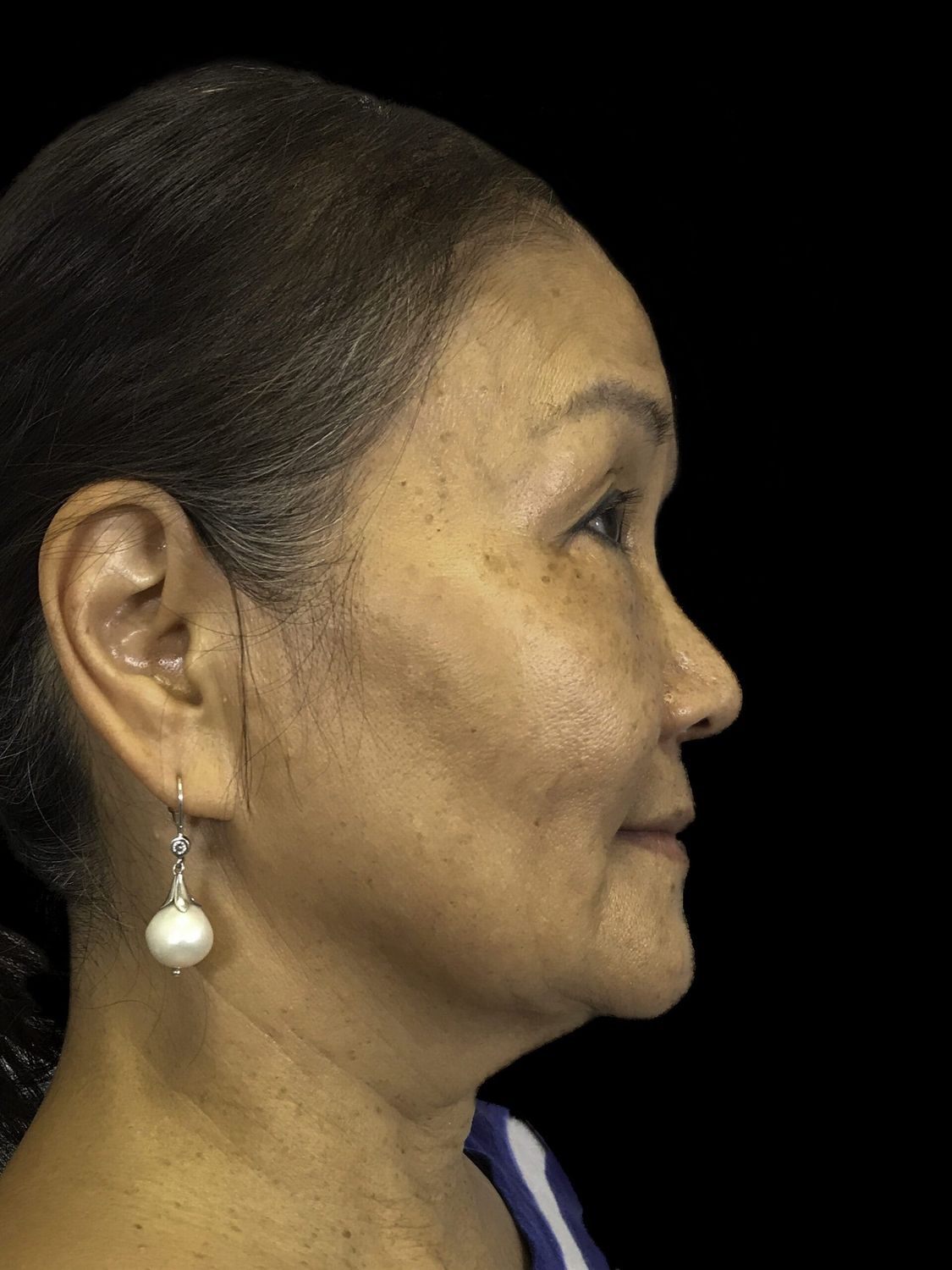 Eyelid Surgery Before & After