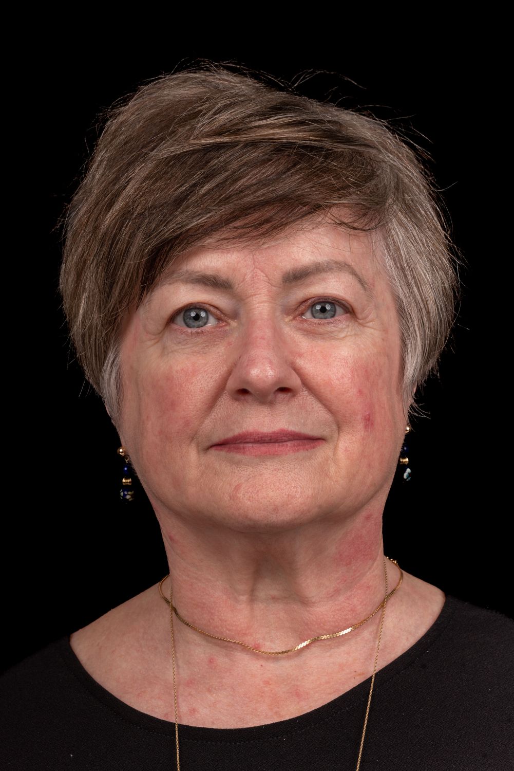 Eyelid Surgery Before & After