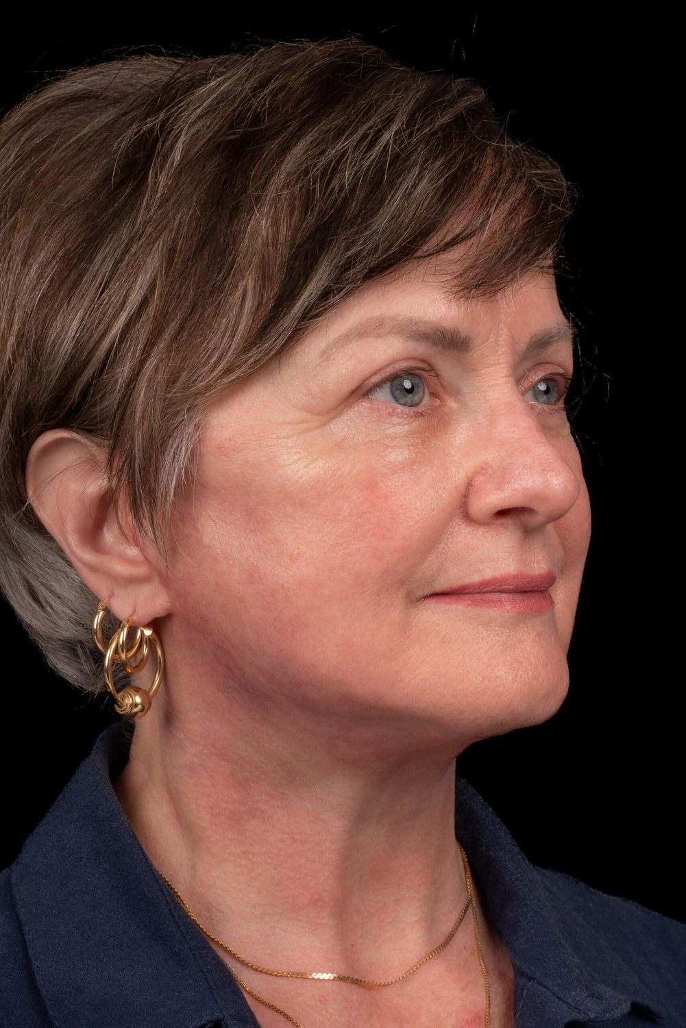 Eyelid Surgery Before & After