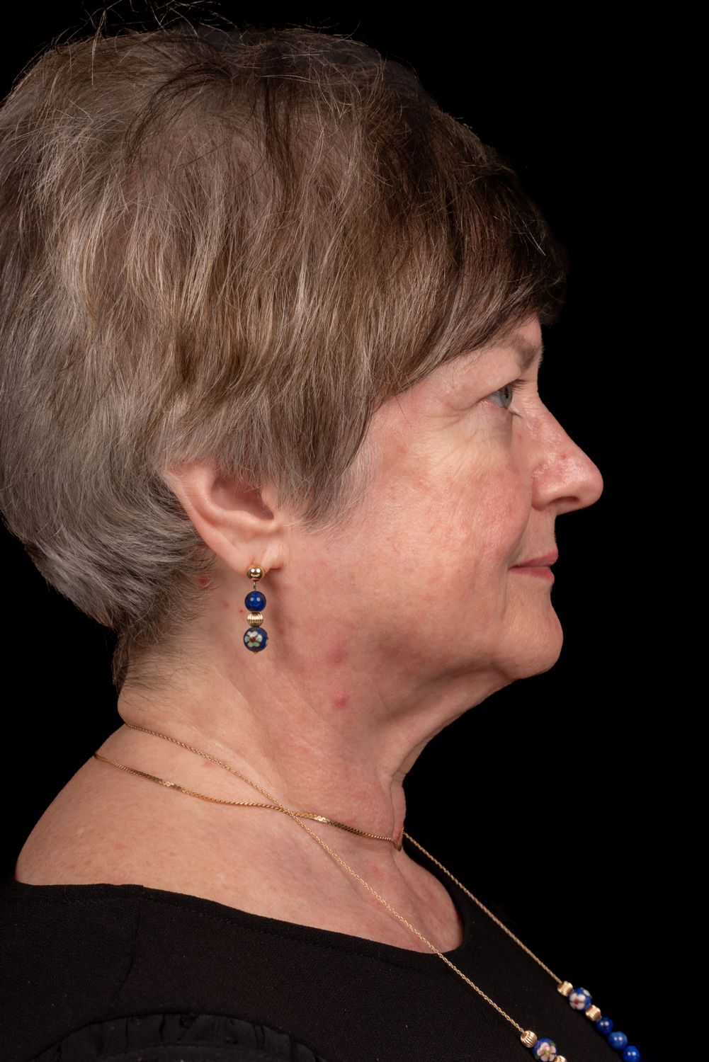 Eyelid Surgery Before & After