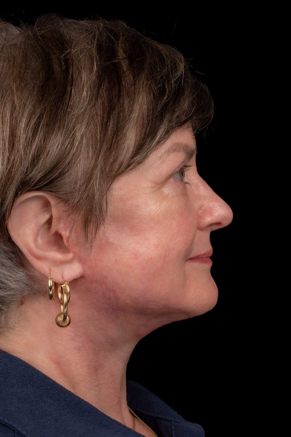 Eyelid Surgery Before & After