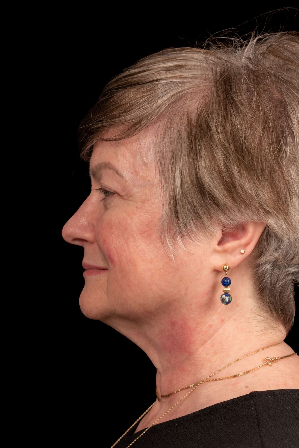 Eyelid Surgery Before & After