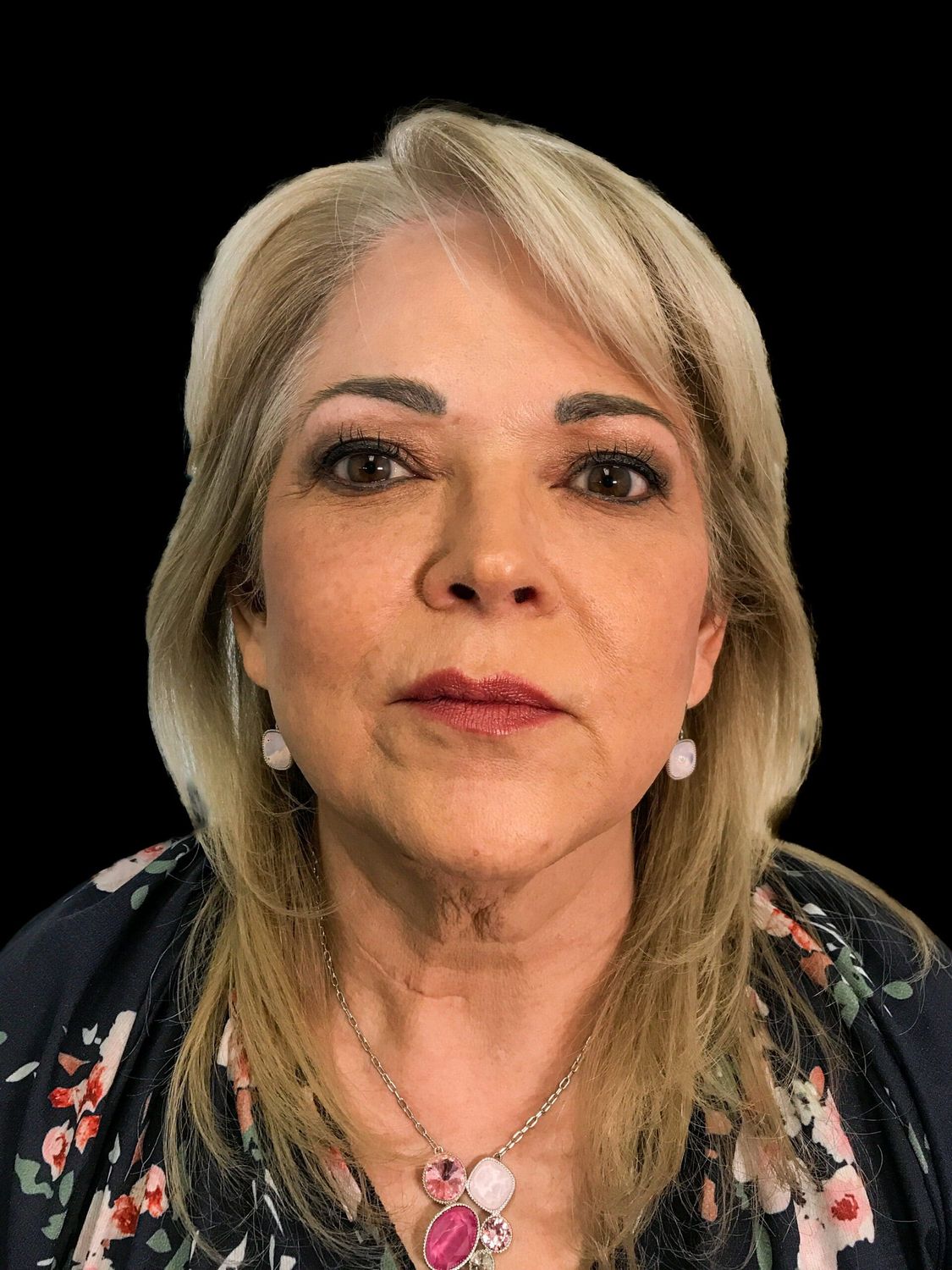 Eyelid Surgery Before & After