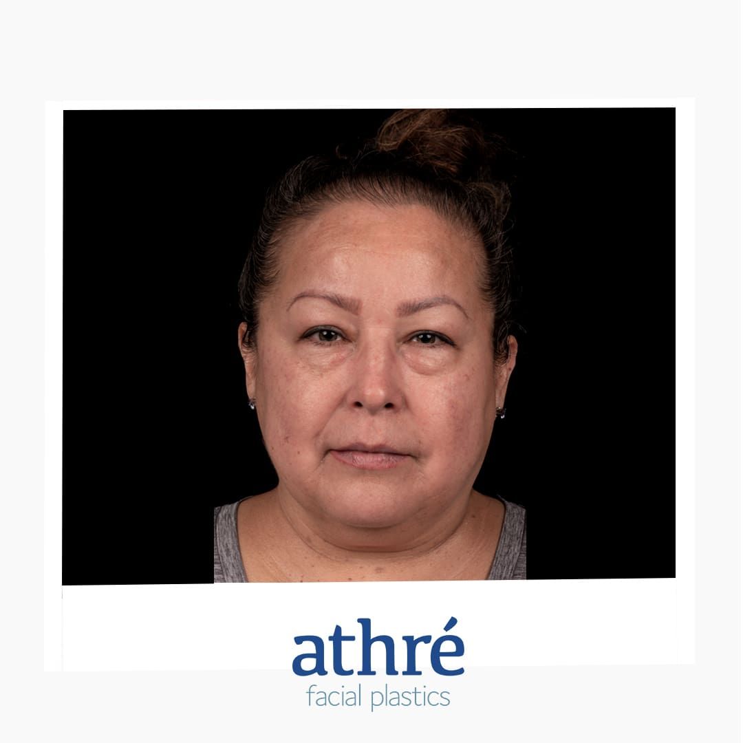 Eyelid Surgery Before & After