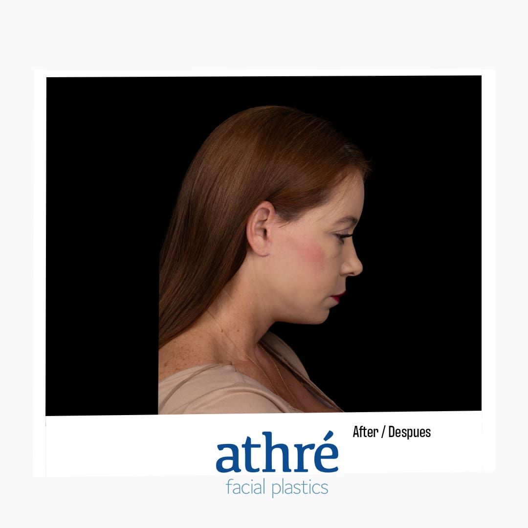 Eyelid Surgery Before & After