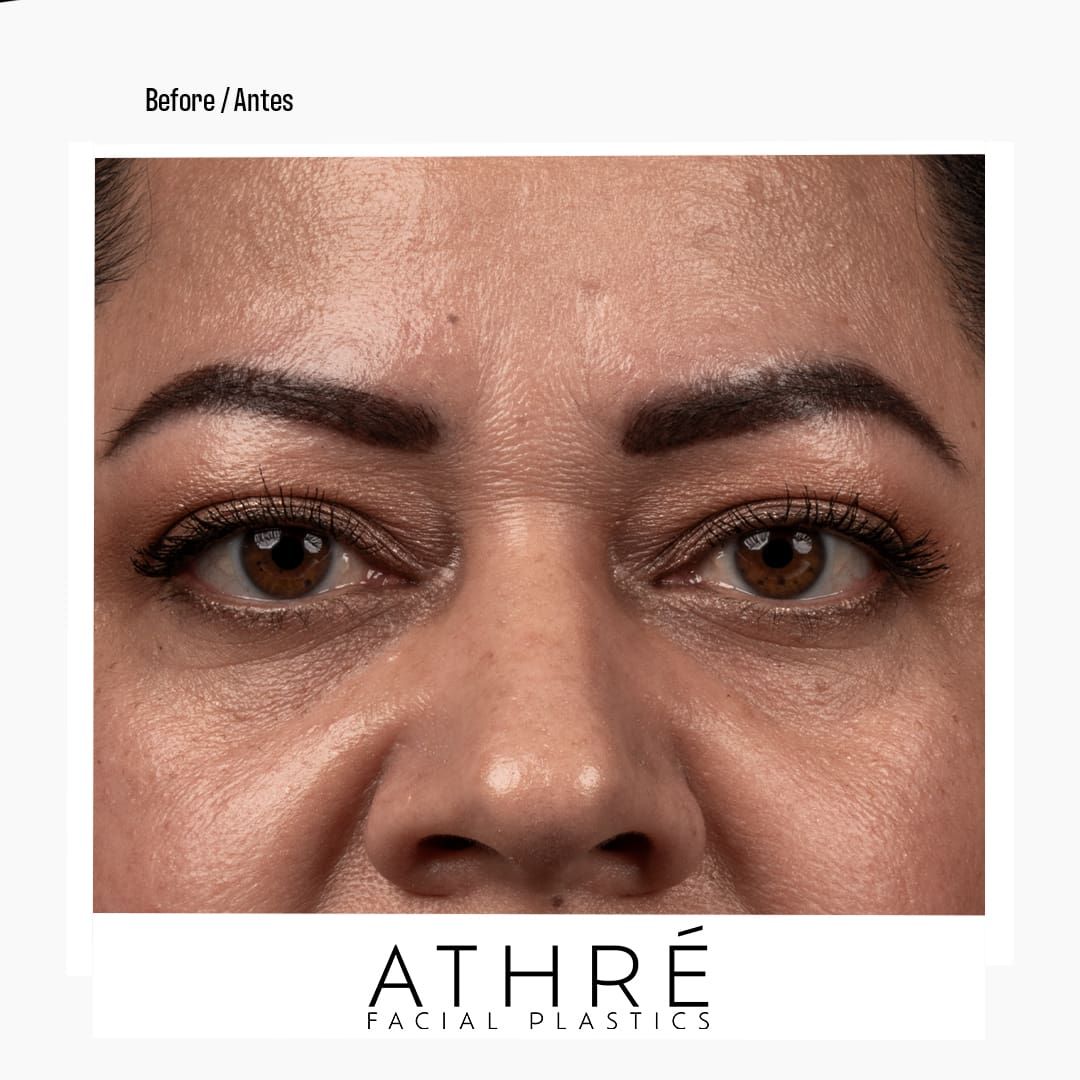 Eyelid Surgery Before & After