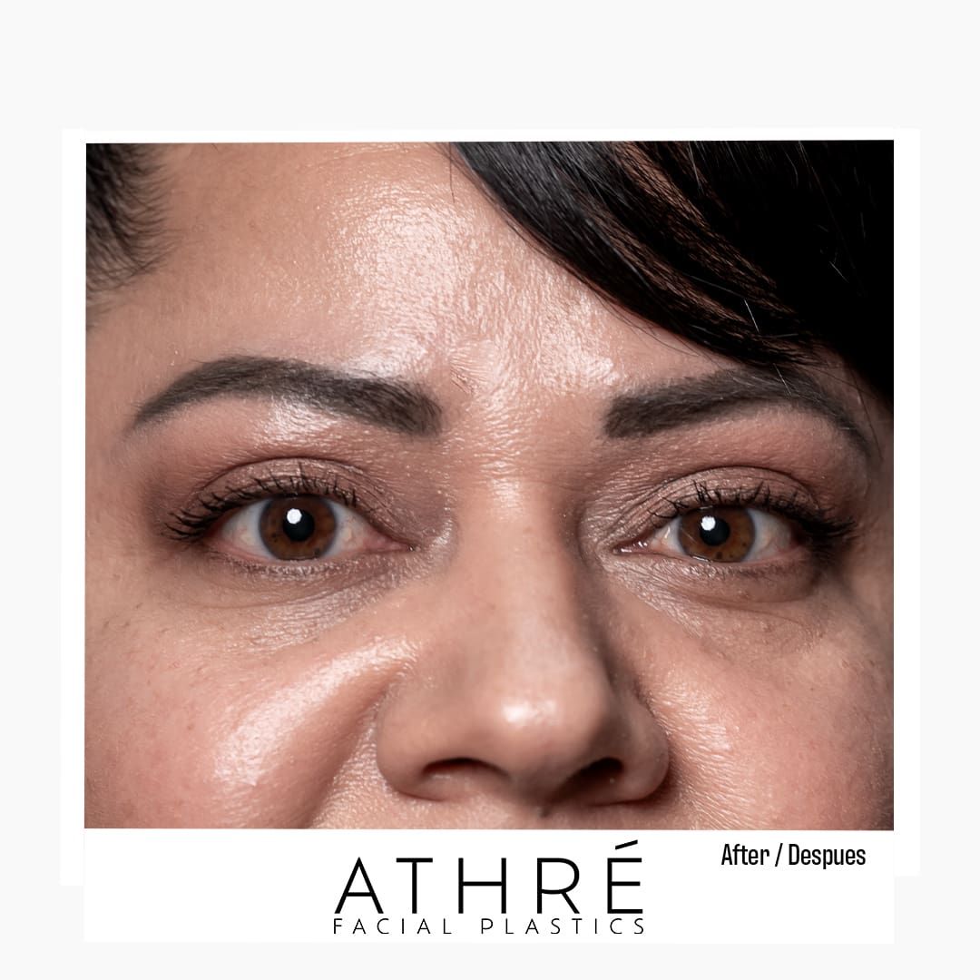 Eyelid Surgery Before & After