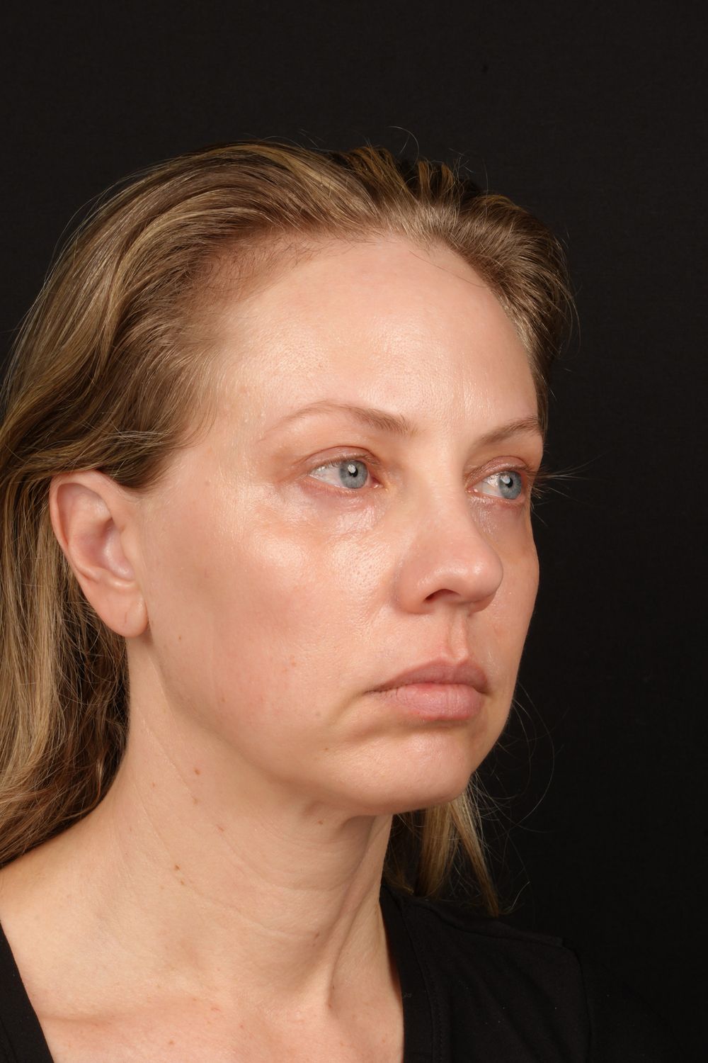 Eyelid Surgery Before & After