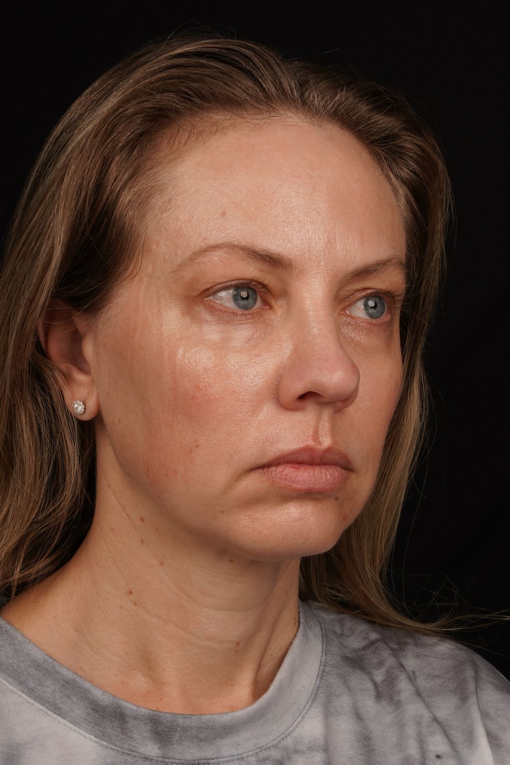 Eyelid Surgery Before & After