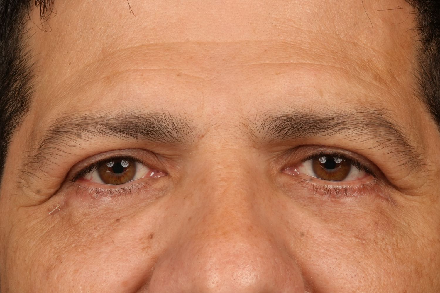 Eyelid Surgery Before & After