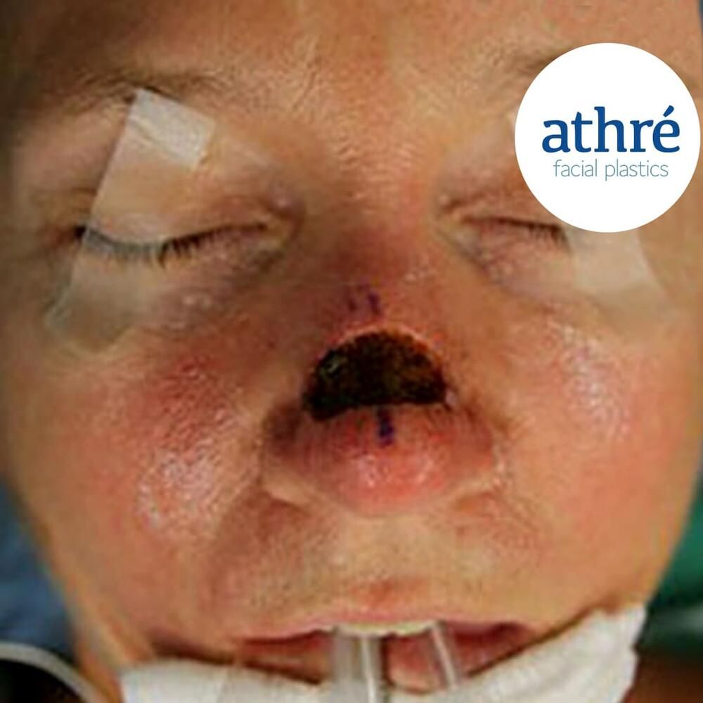 Rhinoplasty Before & After