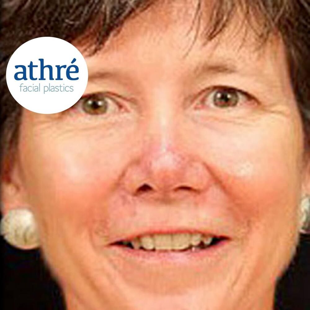 Rhinoplasty Before & After