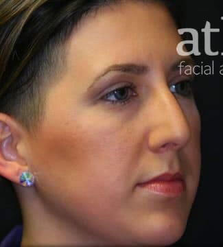 Rhinoplasty Before & After