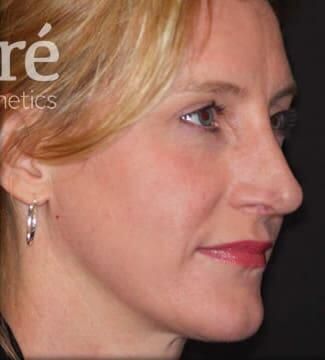 Rhinoplasty Before & After