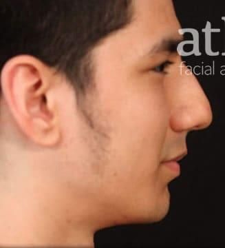 Rhinoplasty Before & After