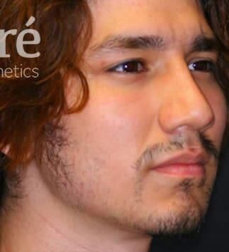 Rhinoplasty Before & After