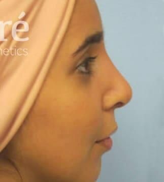 Rhinoplasty Before & After