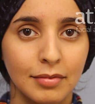 Rhinoplasty Before & After