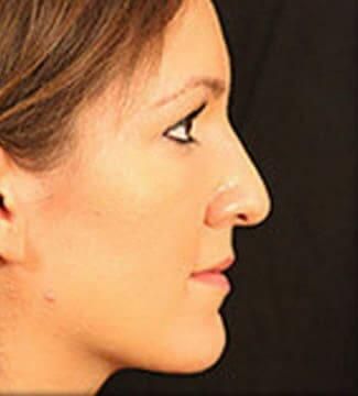 Rhinoplasty Before & After
