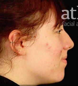 Rhinoplasty Before & After
