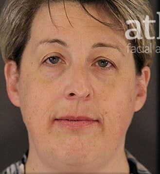 Rhinoplasty Before & After