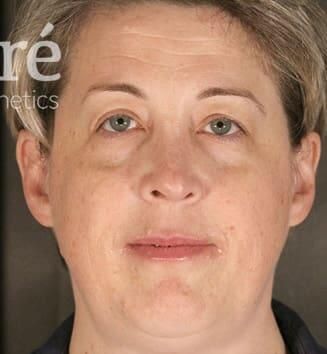 Rhinoplasty Before & After