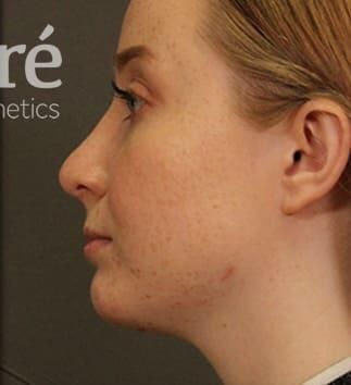 Rhinoplasty Before & After