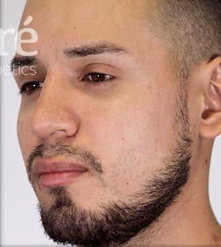 Rhinoplasty Before & After