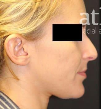 Rhinoplasty Before & After