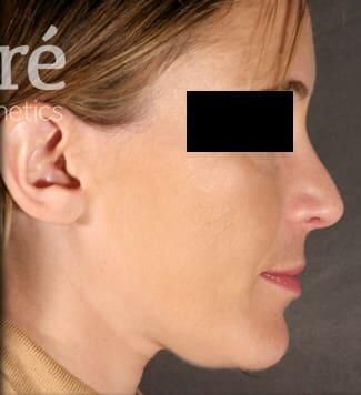 Rhinoplasty Before & After
