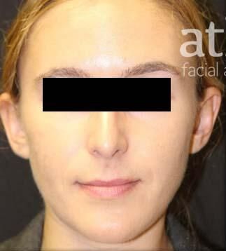 Rhinoplasty Before & After