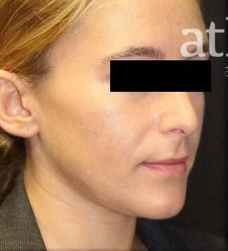 Rhinoplasty Before & After