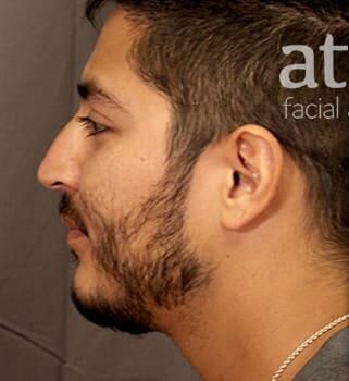 Rhinoplasty Before & After