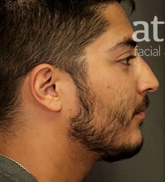 Rhinoplasty Before & After