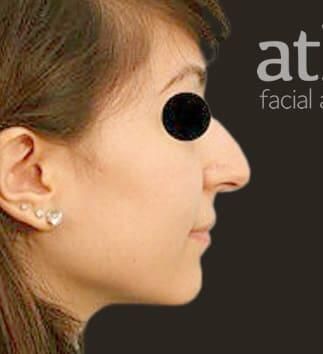 Rhinoplasty Before & After