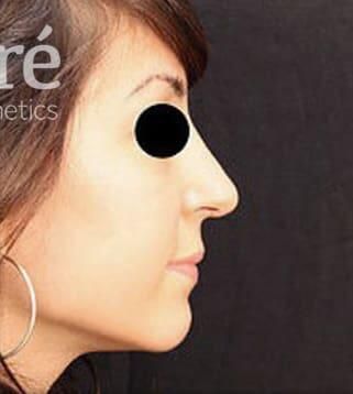Rhinoplasty Before & After