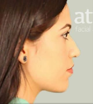 Rhinoplasty Before & After