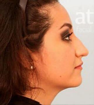 Rhinoplasty Before & After