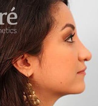 Rhinoplasty Before & After