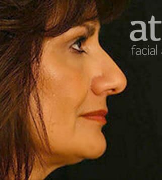 Rhinoplasty Before & After