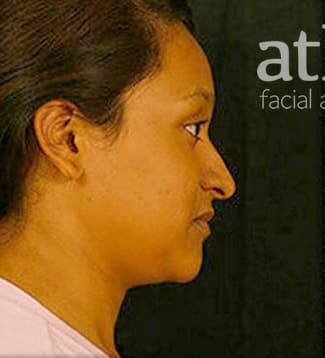 Rhinoplasty Before & After