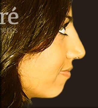Rhinoplasty Before & After