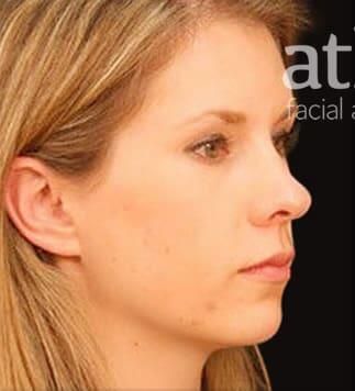 Rhinoplasty Before & After
